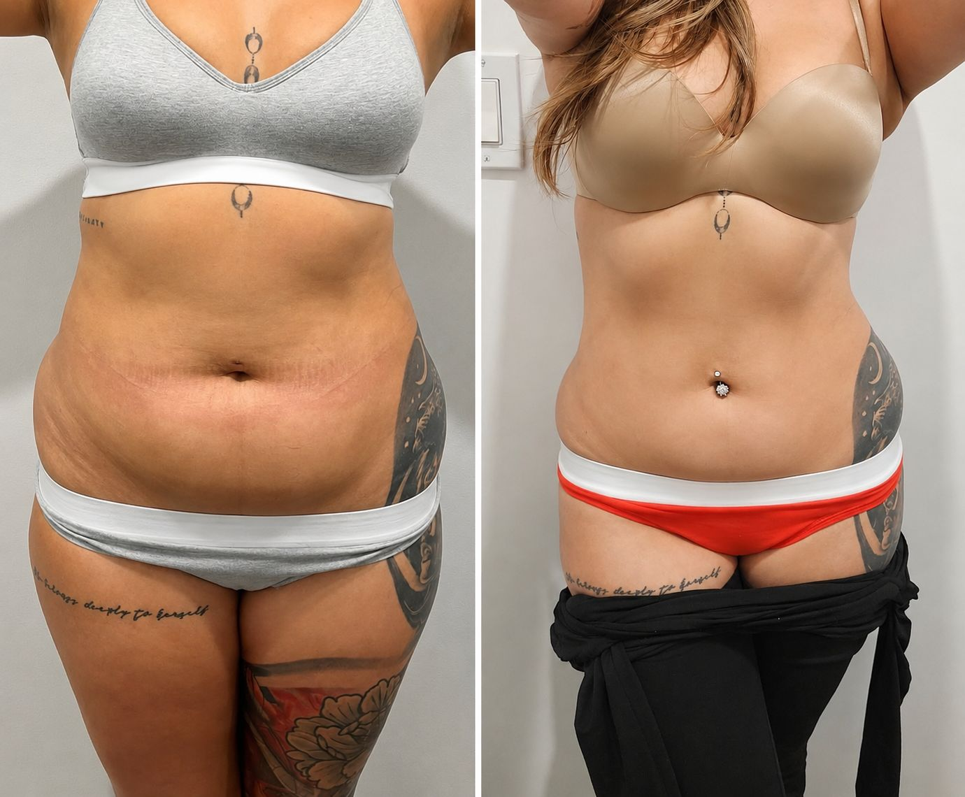 Before and after body transformation Client 06 at Contour Aesthetics By Abi