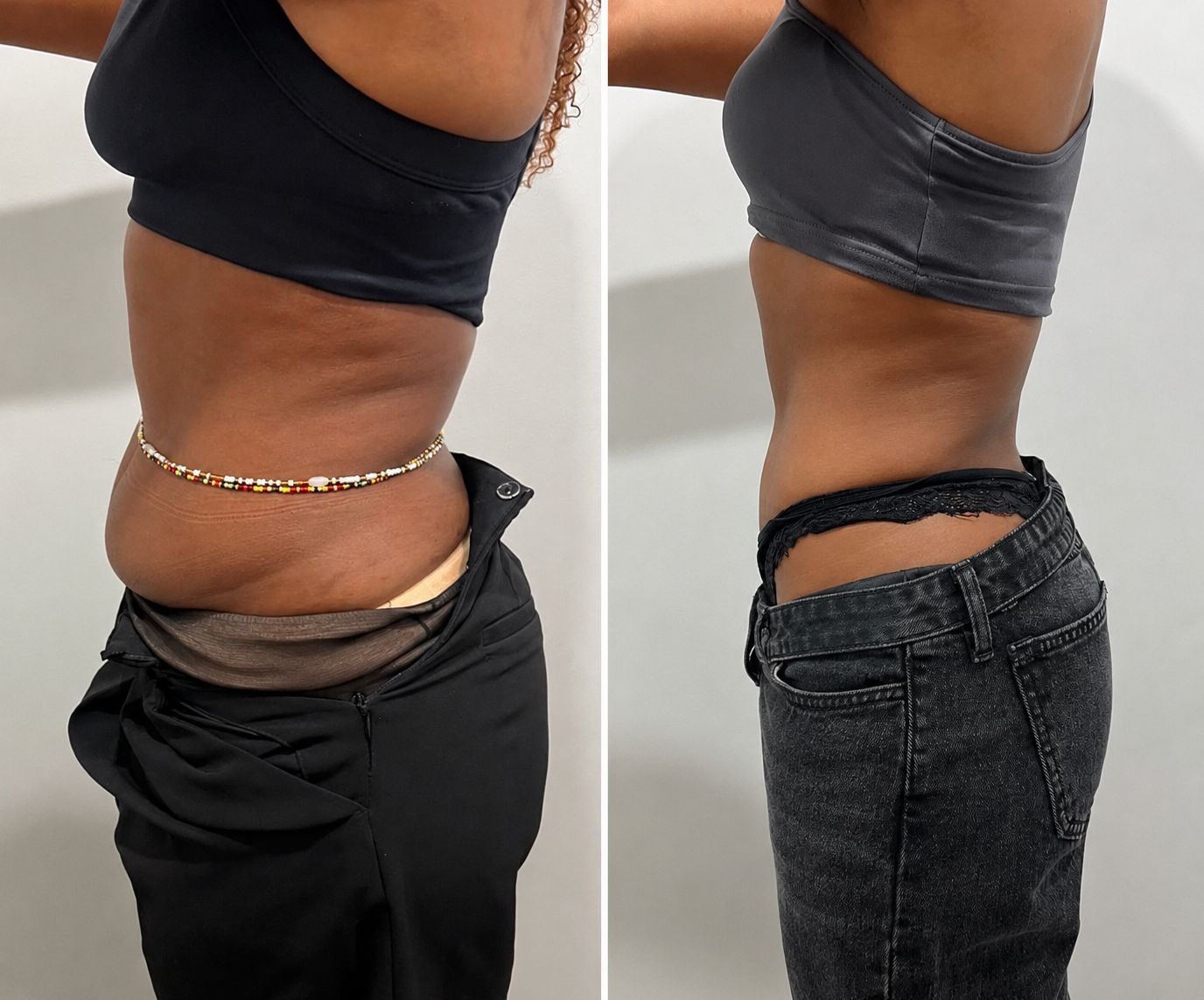 Before and after body transformation Client 03 at Contour Aesthetics By Abi