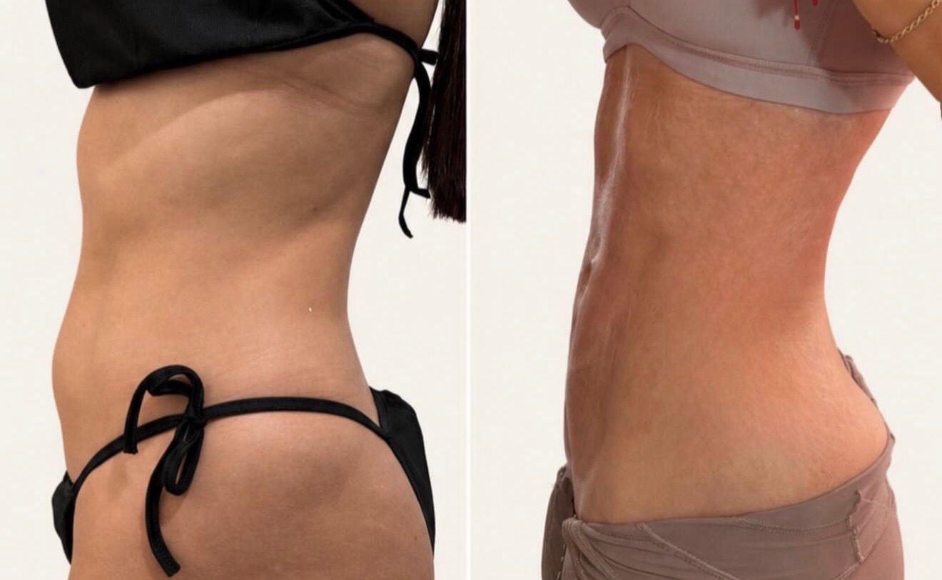 Before and after body transformation Client 02 at Contour Aesthetics By Abi