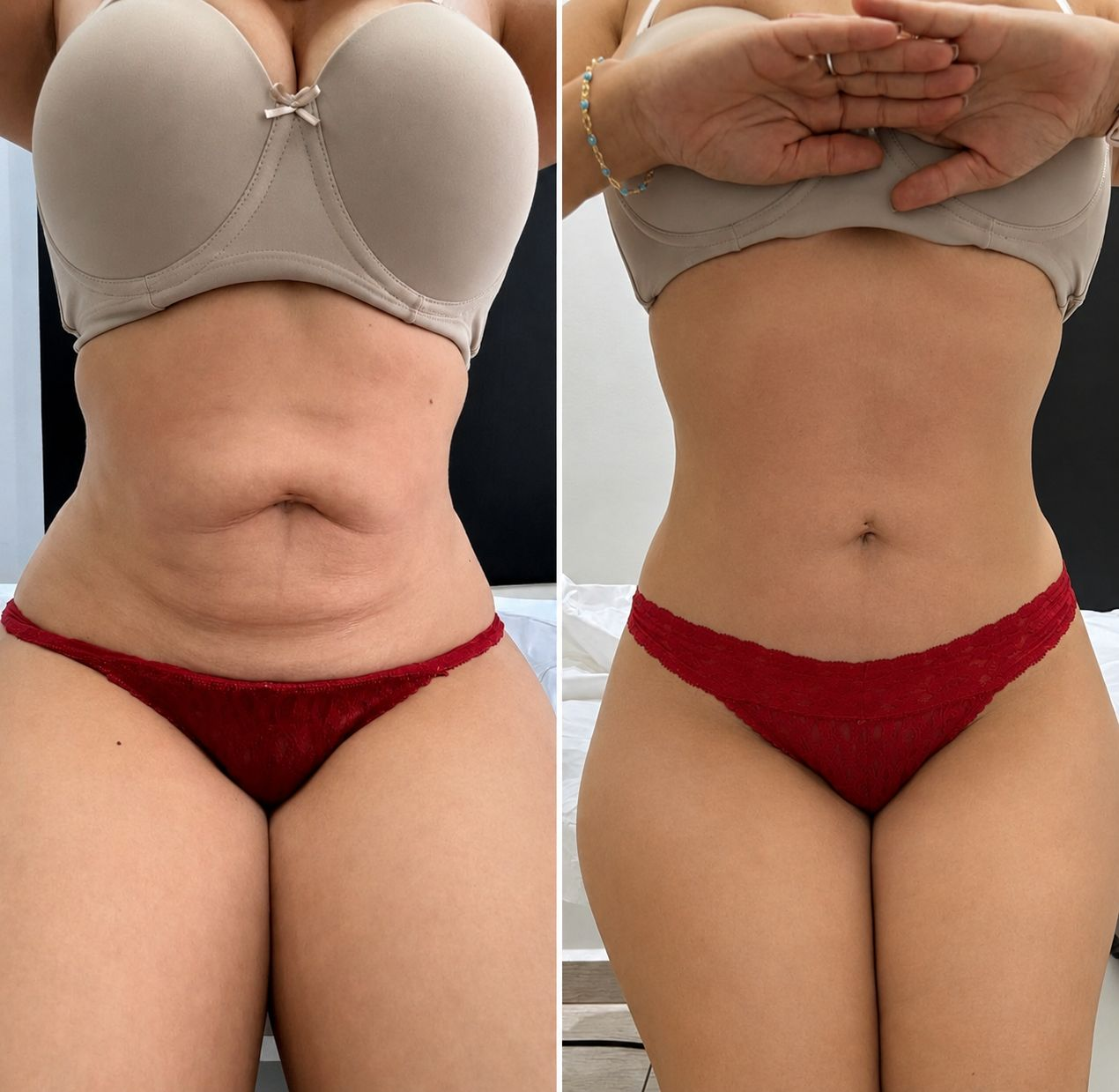 Before and after body transformation Client 01 at Contour Aesthetics By Abi