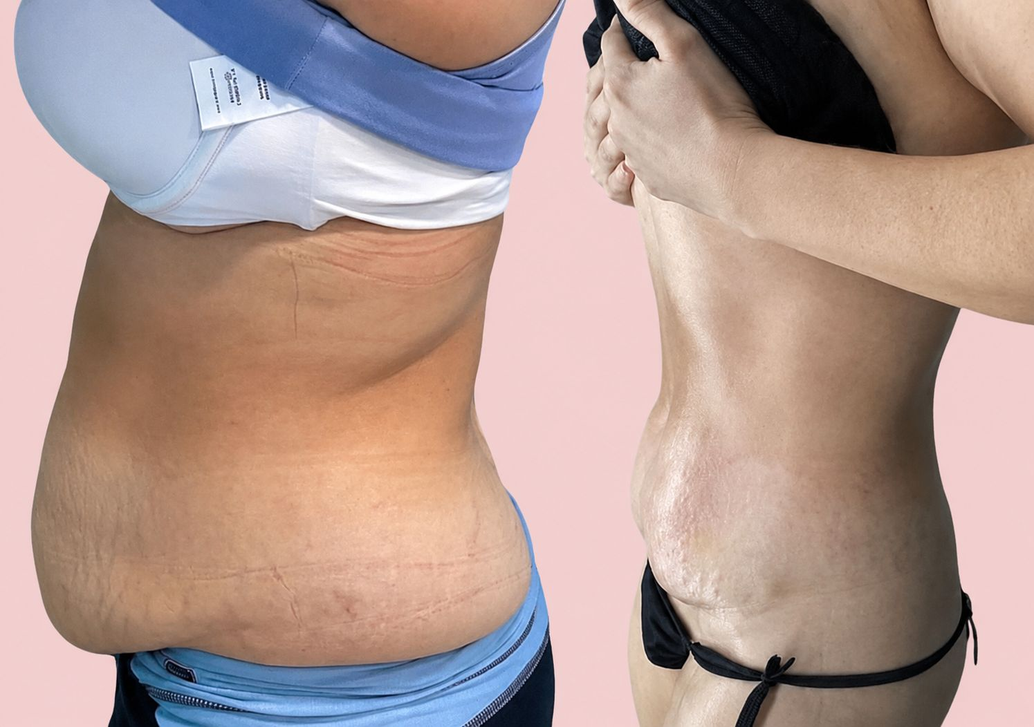 Before and after body transformation Client 04 at Contour Aesthetics By Abi