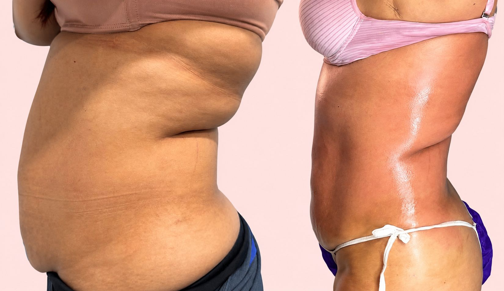 Before and after body transformation Client 05 at Contour Aesthetics By Abi